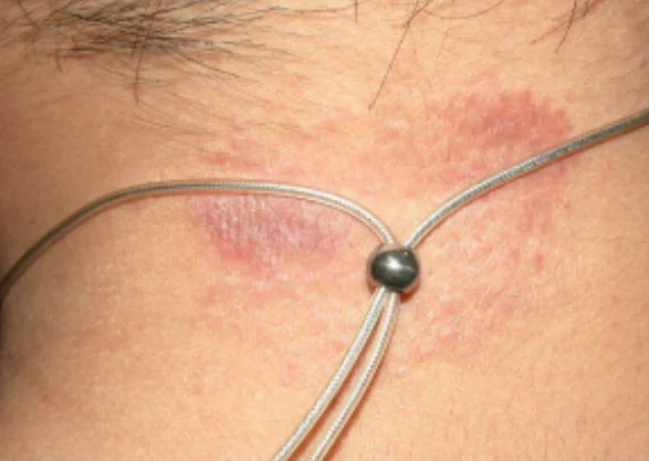 Close-up of a skin allergy reaction caused by jewelry, showing redness and irritation around the contact area.